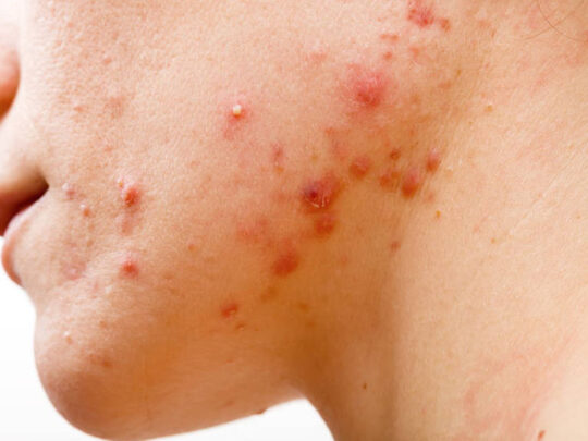 Top 10 homeopathic remedies for acne